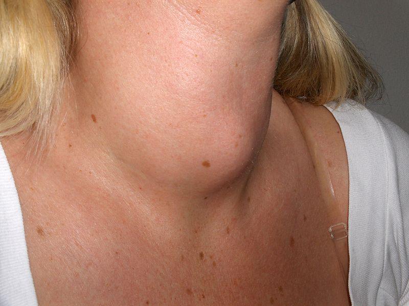 When A Lump In The Neck Is Cause For Concern Lakeshore Ear Nose 