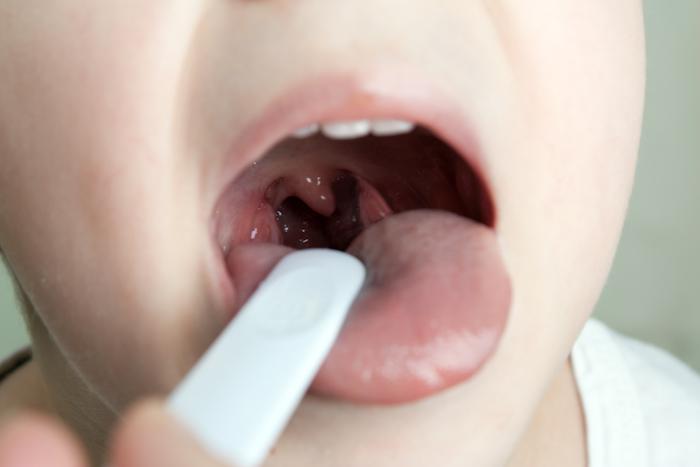 Should My Child Have Their Tonsils Removed Lakeshore Ear Nose 